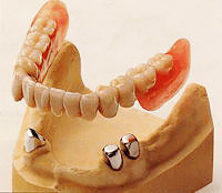茶筒の原理を利用したコーヌスクローネ義歯