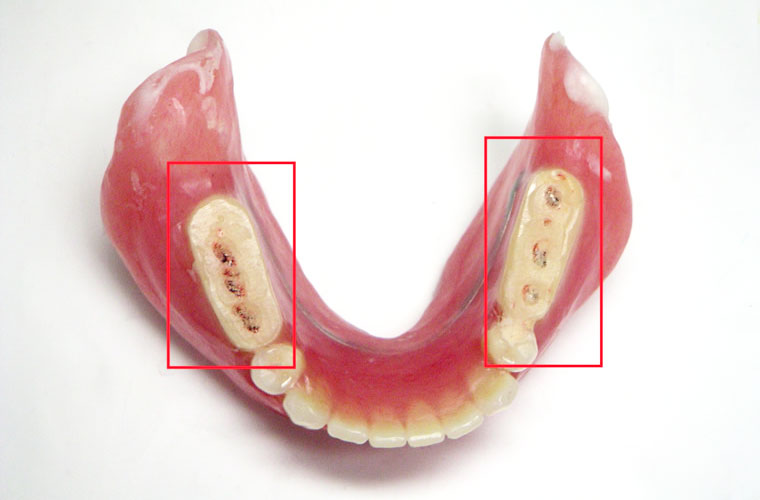診断用義歯の利用