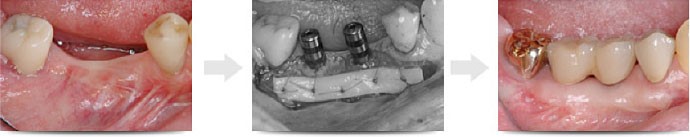 見た目も修復できる歯肉移植手術